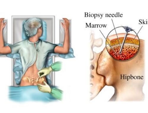 Bone Marrow Concentrate Collection- Risks and Expectations