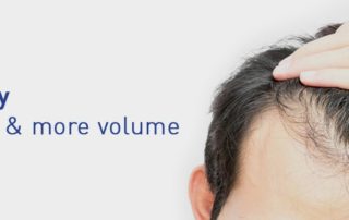 Is Platelet Rich Plasma Good for Hair Loss